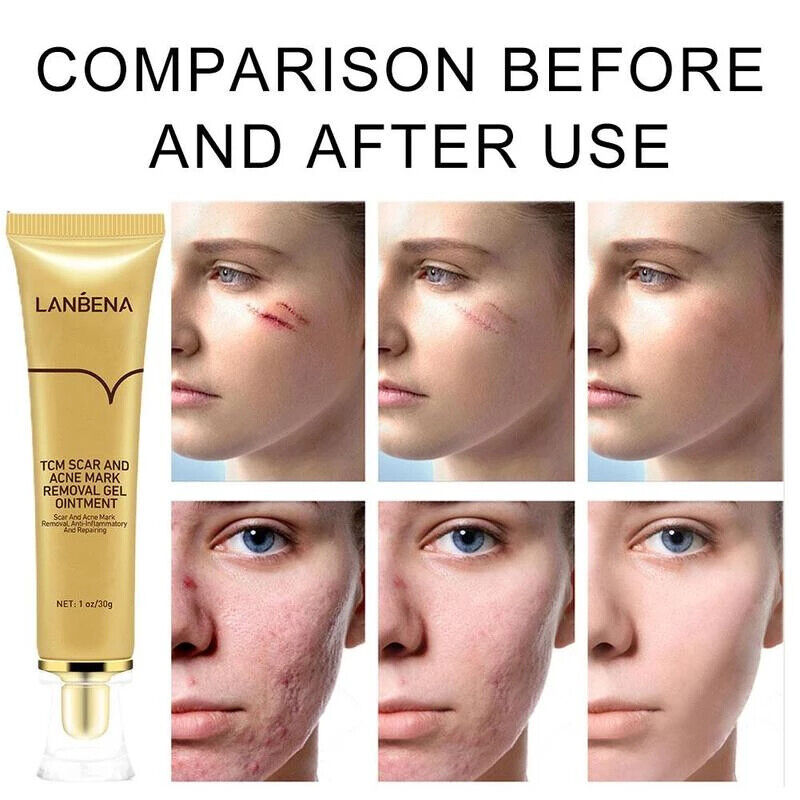 Lanbena TCM Scar and ACNE Mark Removal Gel Ointment - 30 g